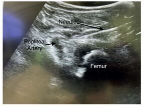 Figure from article: iPACK block with adductor...