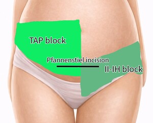 Figure from article: Ultrasound-guided regional...