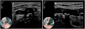 Figure from article: Femoral artery cannulation...