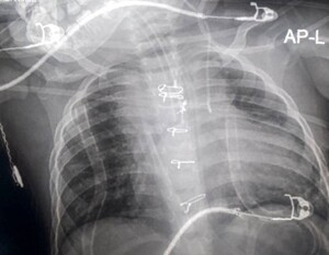 Figure from article: Failure of tracheal tube...